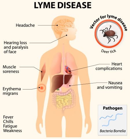 Ziekte Van Lyme Ziekte Van Lyme Symptomen Teek Tekenbeet 7